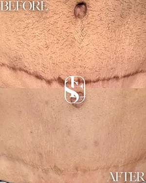Before (top) and after (bottom): tummy-tuck scar camouflage