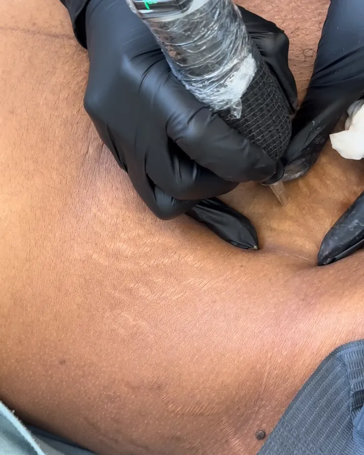 Stretch mark camouflage at SKINEAV in Vaughan
