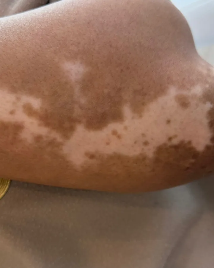 Vitiligo camouflage, colour-matched case by case